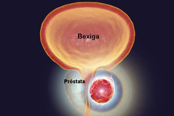 Artigo: Brasil inova no tratamento de próstata